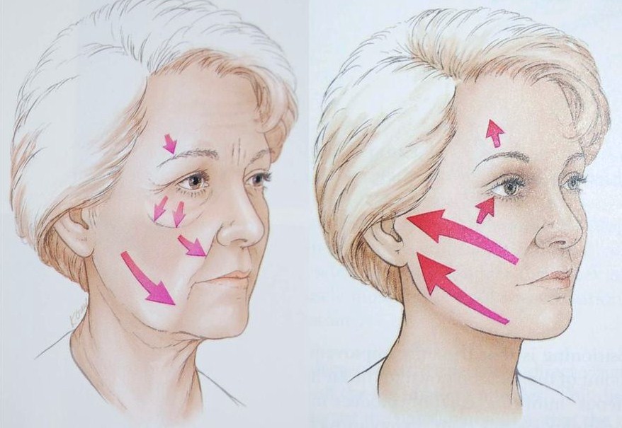 face+lift